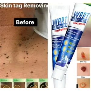 Wart removal cream